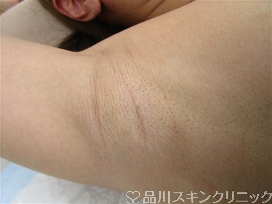 症例NO.42155のBEFORE写真