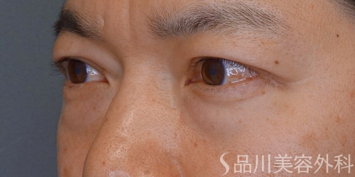 症例NO.74021のBEFORE写真