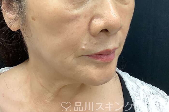 症例NO.69839のBEFORE写真