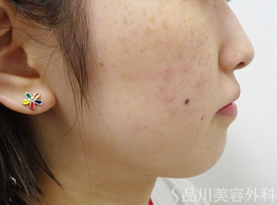 症例NO.74747のBEFORE写真