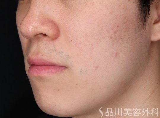 症例NO.70419のAFTER写真