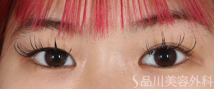 症例NO.72362のBEFORE写真