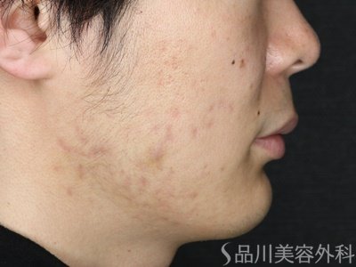 症例NO.70346のAFTER写真