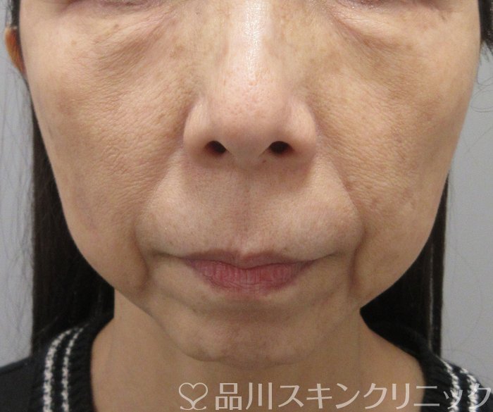 症例NO.74273のBEFORE写真