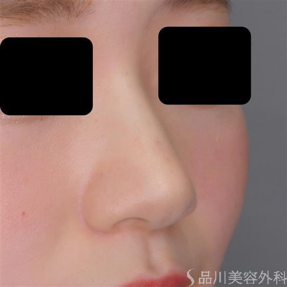 症例NO.54217のAFTER写真
