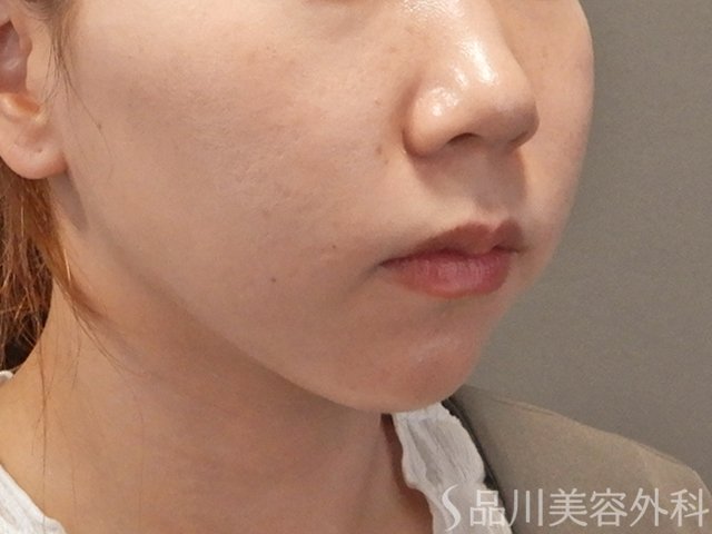 症例NO.74986のAFTER写真