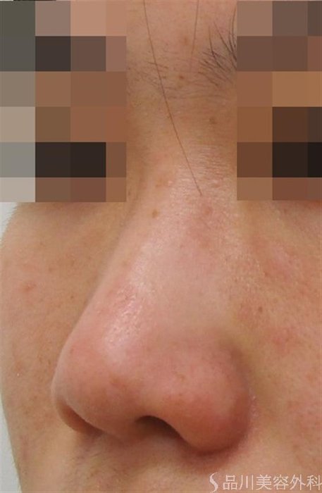症例NO.43591のBEFORE写真