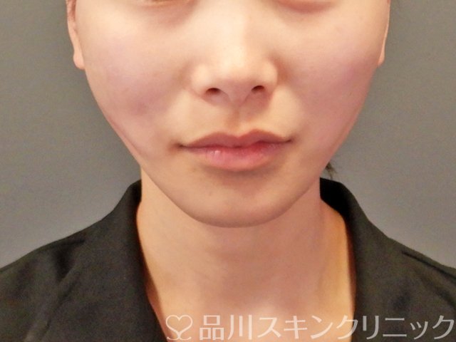 症例NO.64720のAFTER写真