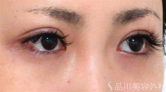 症例NO.27048のAFTER写真