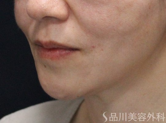症例NO.74431のAFTER写真