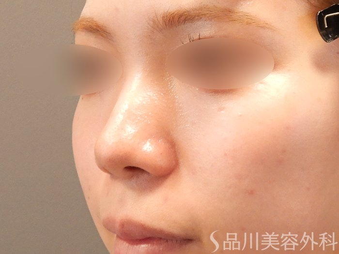 症例NO.70794のBEFORE写真