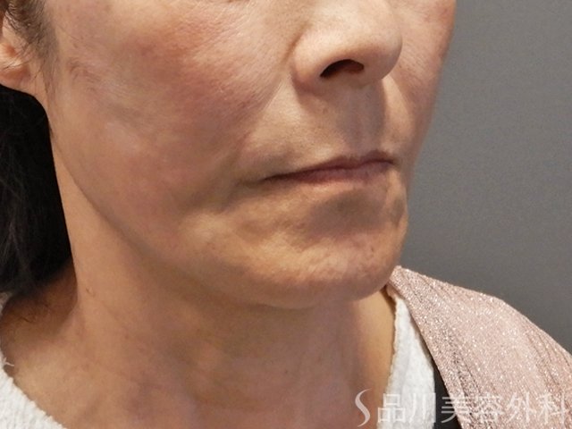 症例NO.71868のAFTER写真