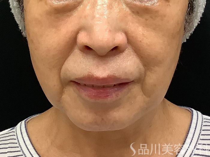 症例NO.67794のBEFORE写真