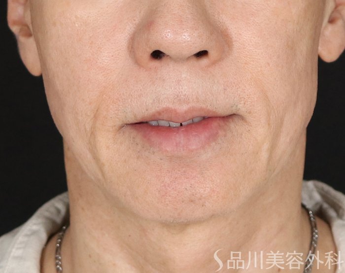 症例NO.73875のBEFORE写真