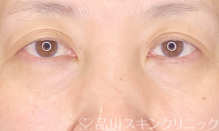 症例NO.69813のBEFORE写真