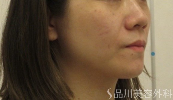 症例NO.75155のBEFORE写真