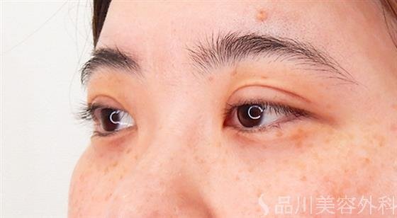 症例NO.61927のAFTER写真