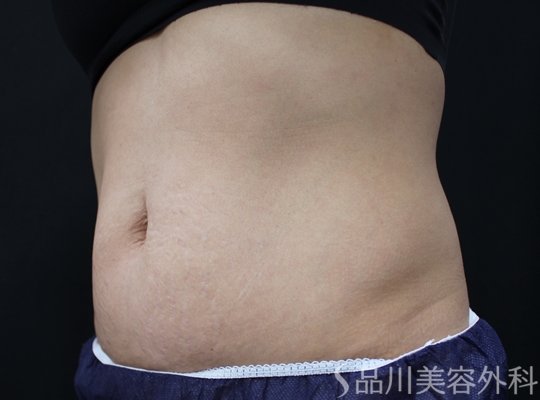 症例NO.75189のBEFORE写真