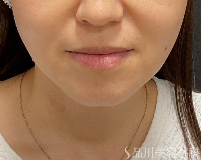 症例NO.75293のBEFORE写真