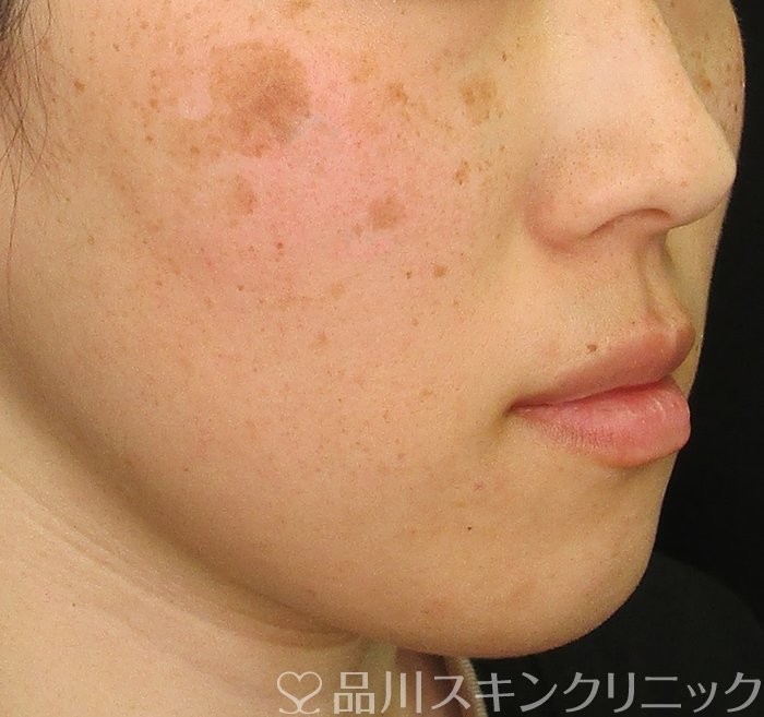 症例NO.72680のBEFORE写真