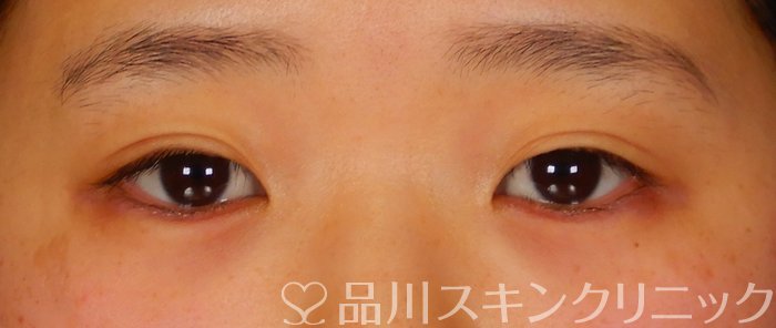 症例NO.63772のAFTER写真