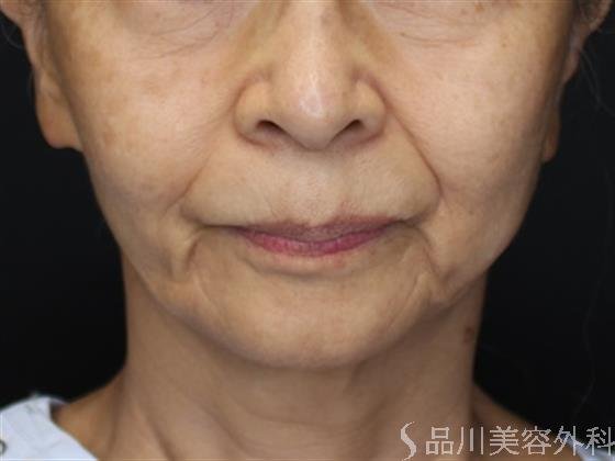 症例NO.57892のBEFORE写真