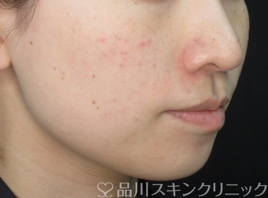 症例NO.70265のAFTER写真