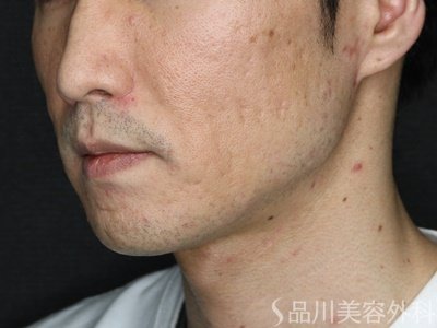 症例NO.71556のBEFORE写真