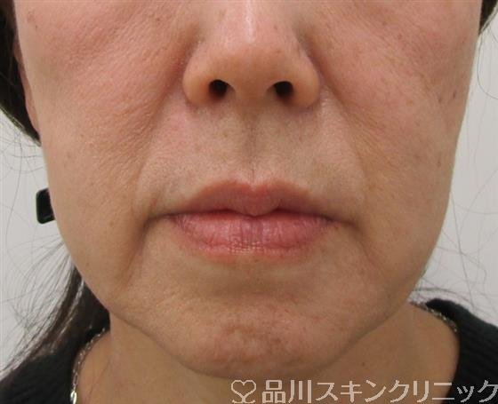 症例NO.42239のBEFORE写真