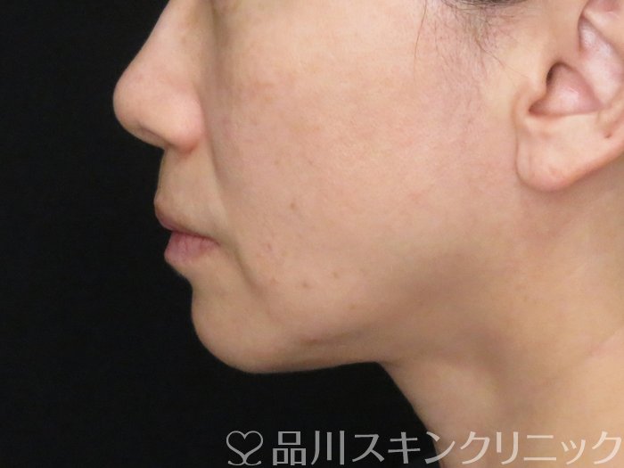 症例NO.65597のBEFORE写真