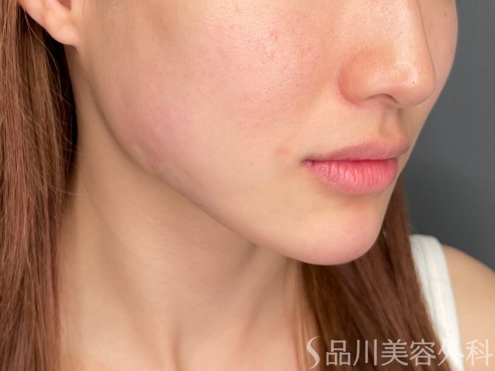 症例NO.63354のAFTER写真