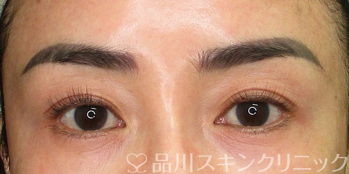 症例NO.70132のBEFORE写真