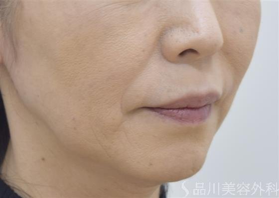 症例NO.46600のBEFORE写真