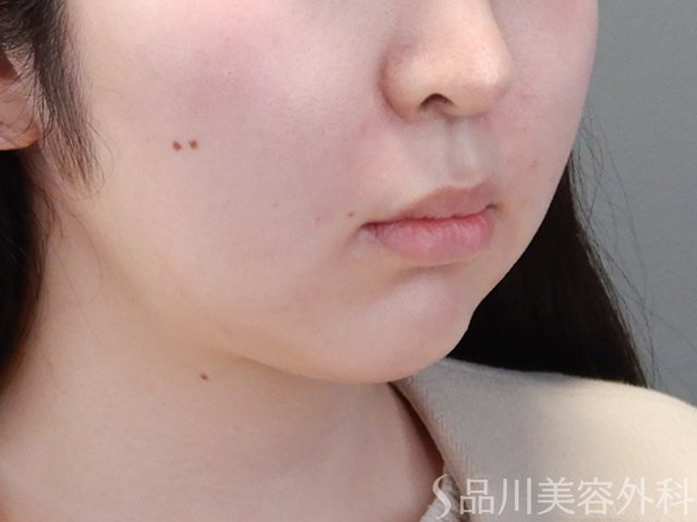 症例NO.68685のAFTER写真
