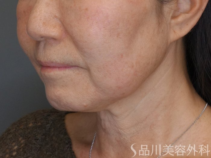 症例NO.72365のBEFORE写真