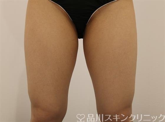 症例NO.43941のBEFORE写真