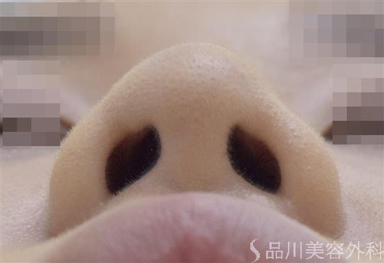 症例NO.49319のAFTER写真