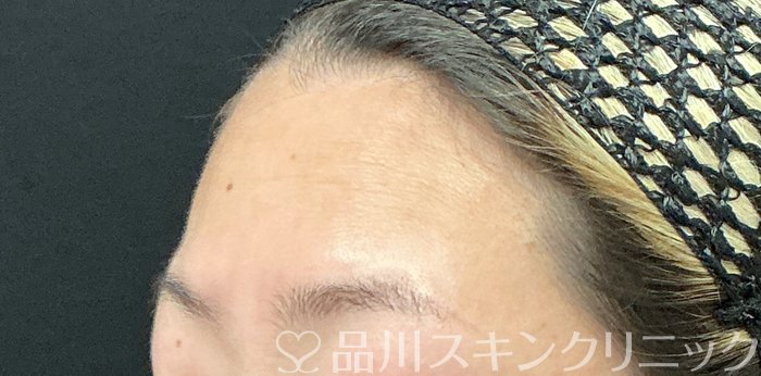 症例NO.73771のBEFORE写真