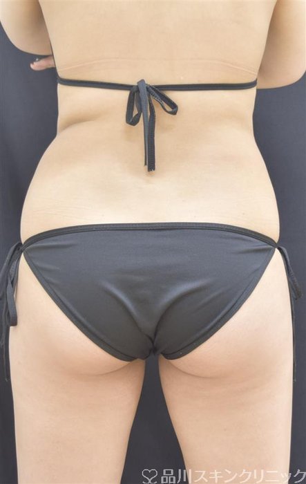 症例NO.44510のBEFORE写真