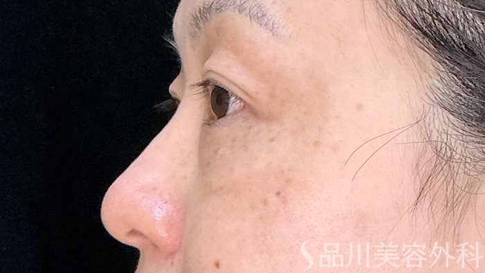 症例NO.72199のBEFORE写真