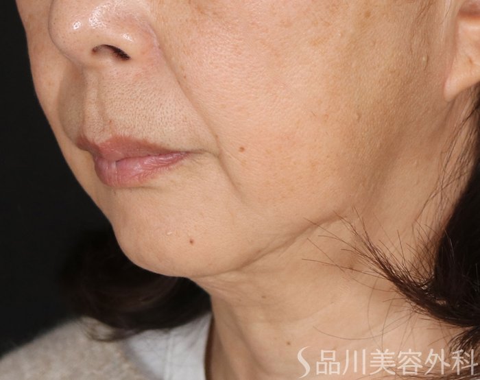 症例NO.72729のBEFORE写真