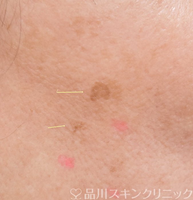 症例NO.70170のBEFORE写真