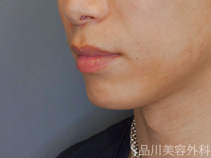 症例NO.70881のAFTER写真