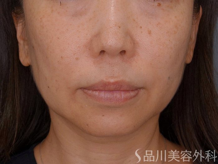 症例NO.74954のBEFORE写真