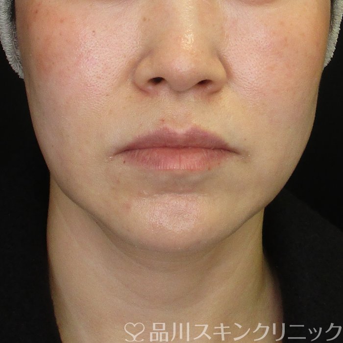 症例NO.74374のBEFORE写真