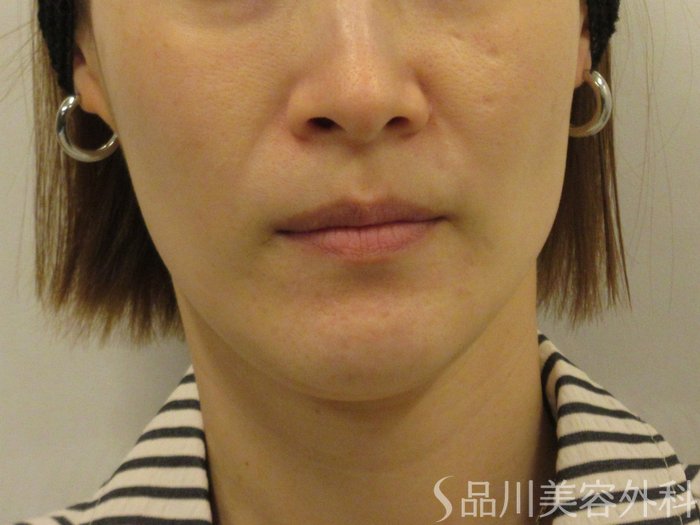 症例NO.74754のBEFORE写真