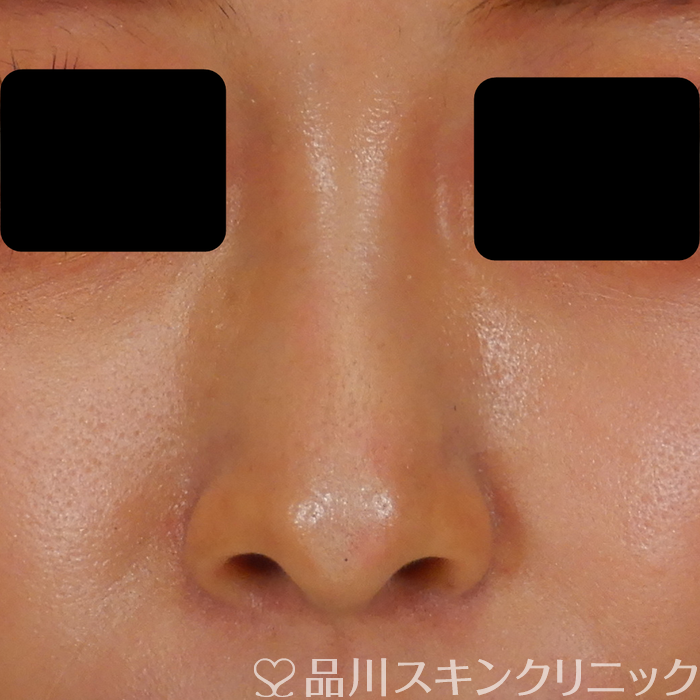 症例NO.69583のAFTER写真