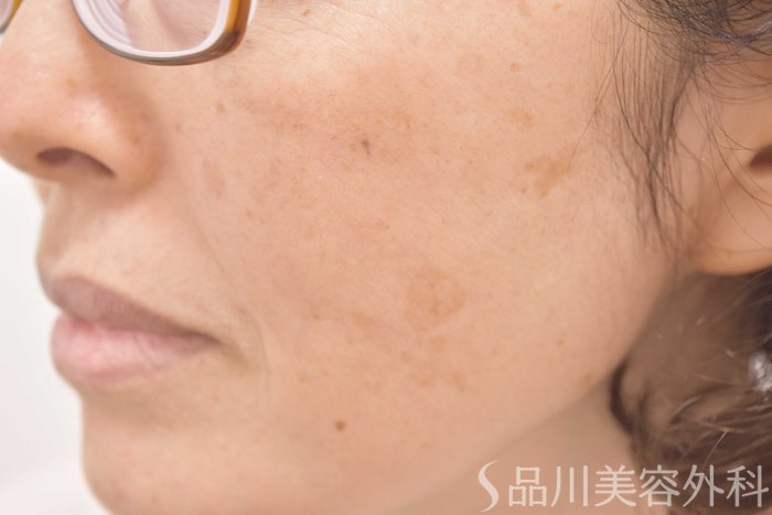 症例NO.64711のBEFORE写真