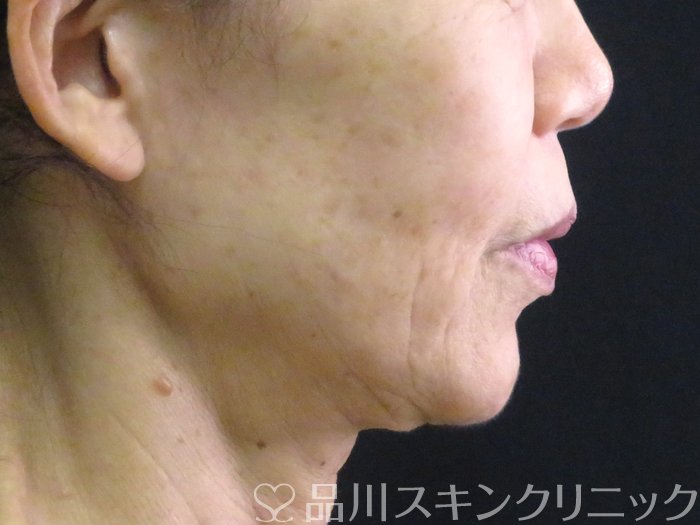 症例NO.70580のBEFORE写真