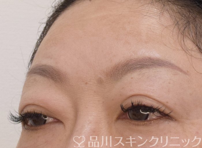 症例NO.75255のAFTER写真